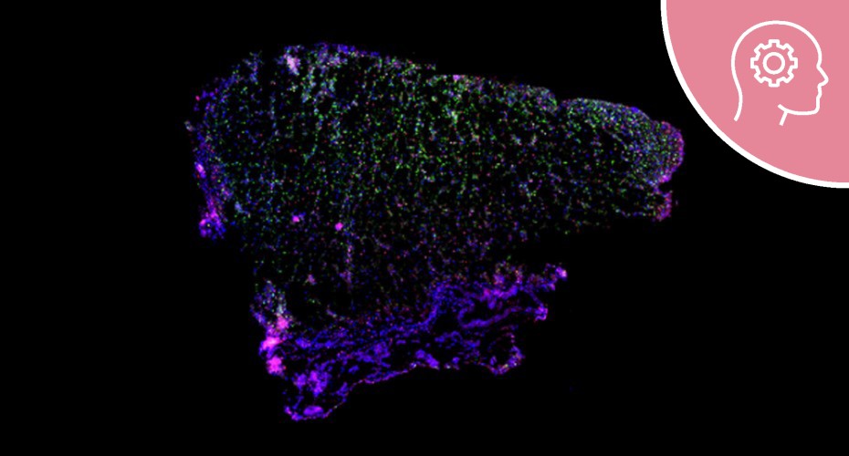 Sample of pre-frontal cortex tissue from an individual with Alzheimer’s disease.